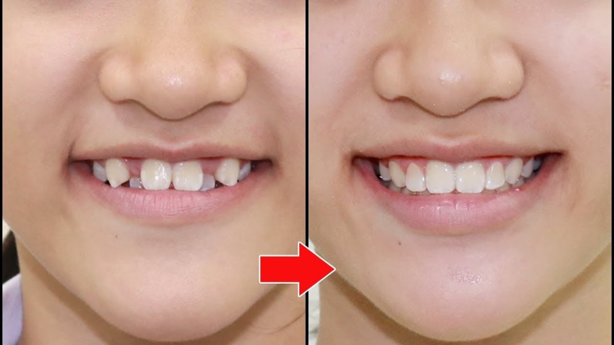 Efekty przed i po aparacie ortodontycznym w Minh Thu Dental Clinic – poprawiony uśmiech