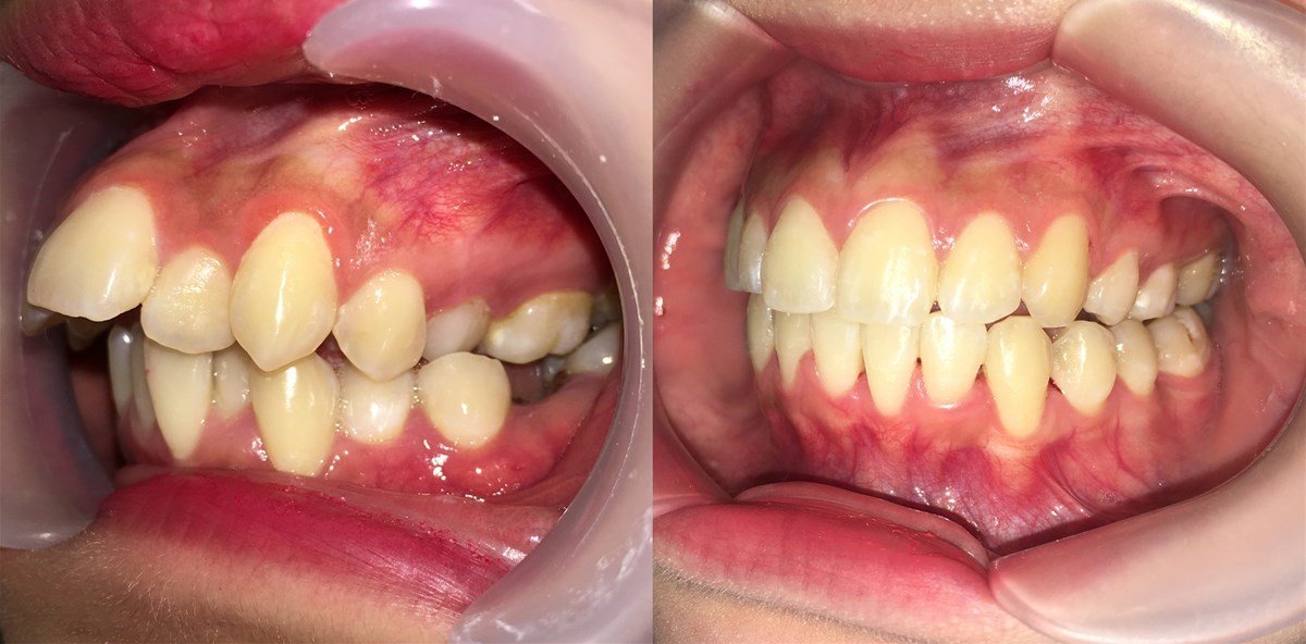 Resultados antes y después de brackets en Minh Thu Dental Clinic – alineación dental mejorada