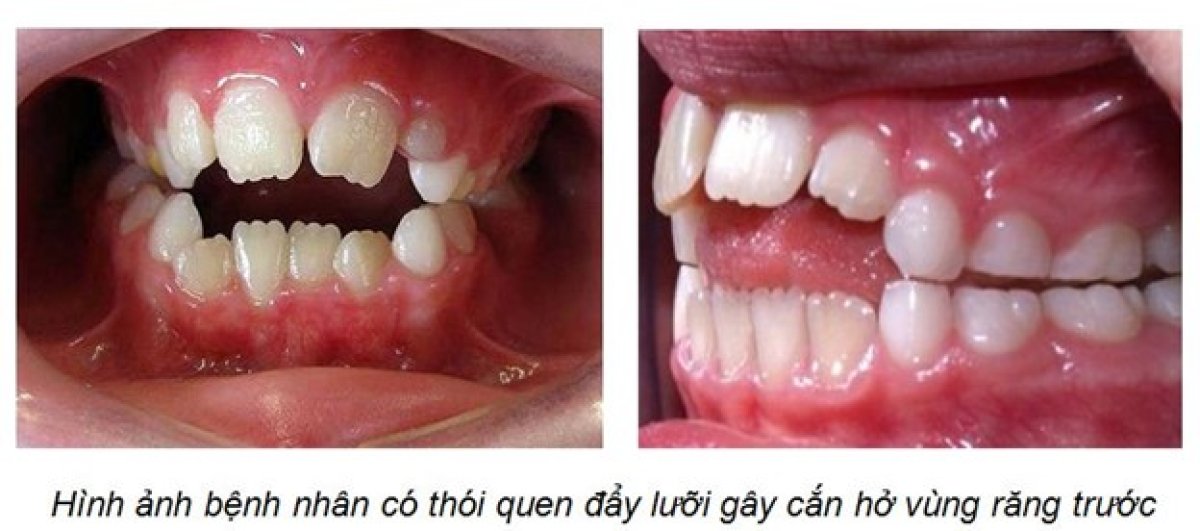 Vorher-nachher-Ergebnis Zahnspange bei offenem Biss in Minh Thu Dental Clinic, sichtbare Korrektur
