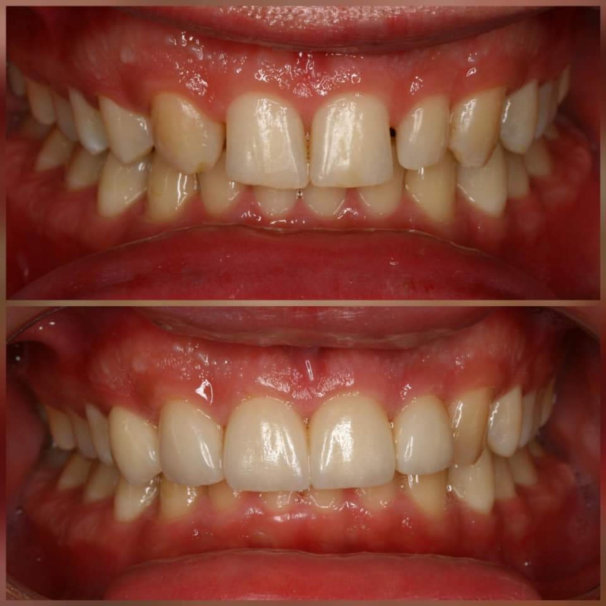 Efekty przed i po licówkach Emax w Minh Thu Dental Clinic – poprawa estetyki uśmiechu
