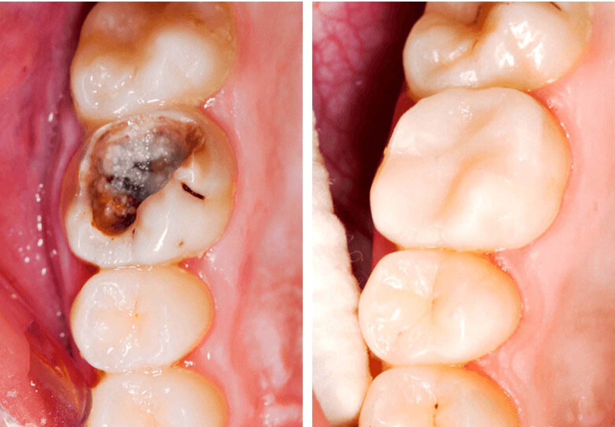 Resultados antes y después de empaste dental compuesto por caries en Minh Thu Dental Clinic