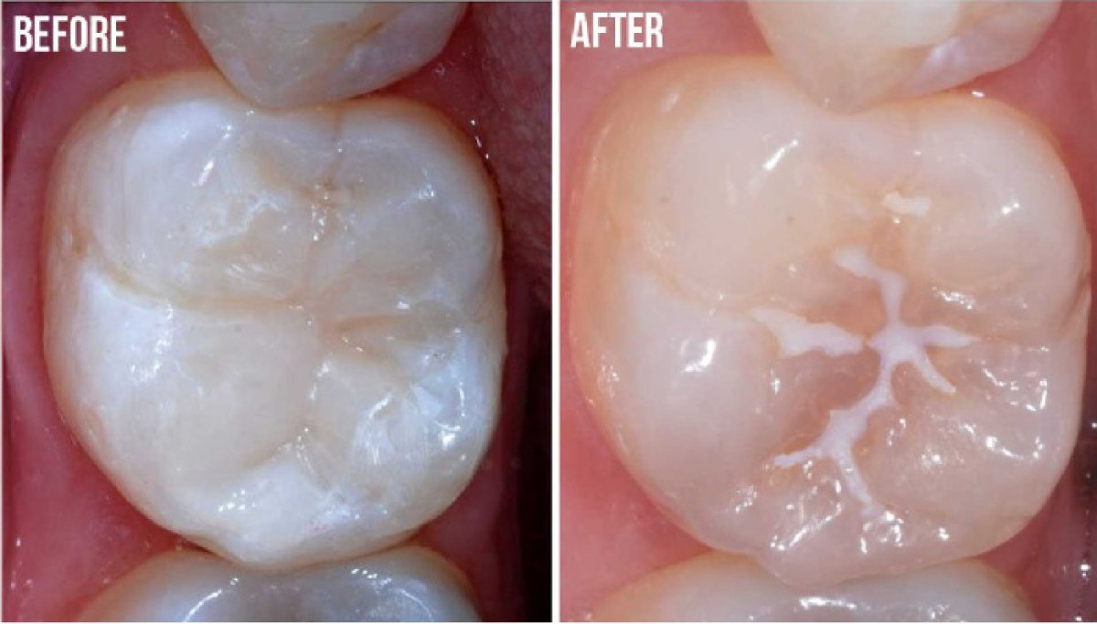 Результаты до и после композитной пломбы в Minh Thu Dental Clinic, восстановленная поверхность зуба