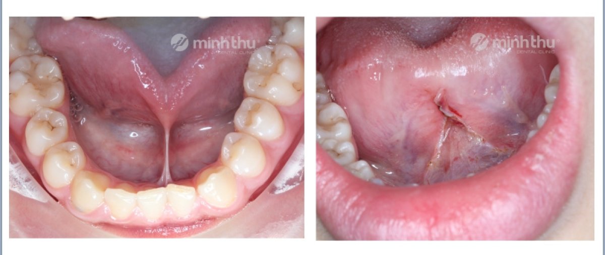 Результаты до и после френэктомии языка в Minh Thu Dental Clinic, улучшена подвижность