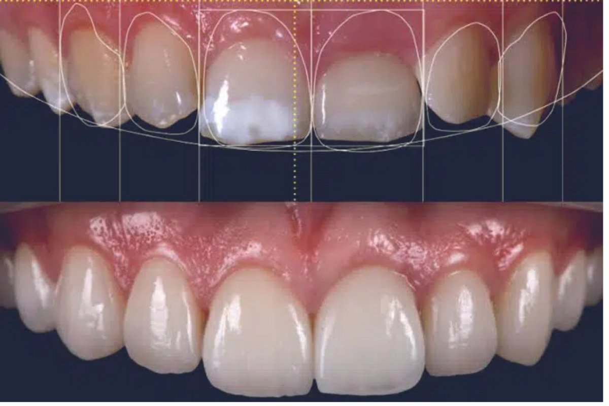 Przed i po licówkach w Minh Thu Dental Clinic, naturalny efekt uśmiechu