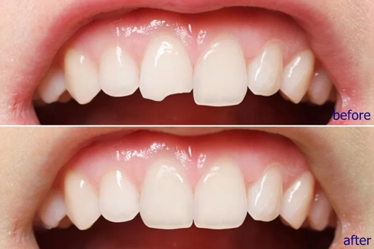 Efekt przed i po licówkach w Minh Thu Dental Clinic – poprawa estetyki uśmiechu