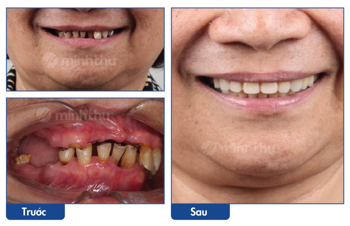 Before and after dental implant results at Minh Thu Dental Clinic – restored smile transformation