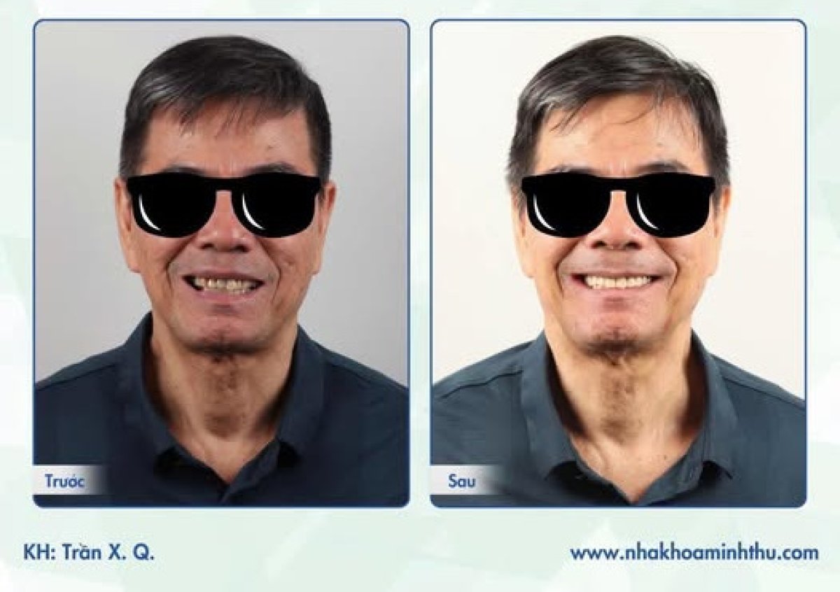 Before and after dental implant results at Minh Thu Dental Clinic, improved smile restoration
