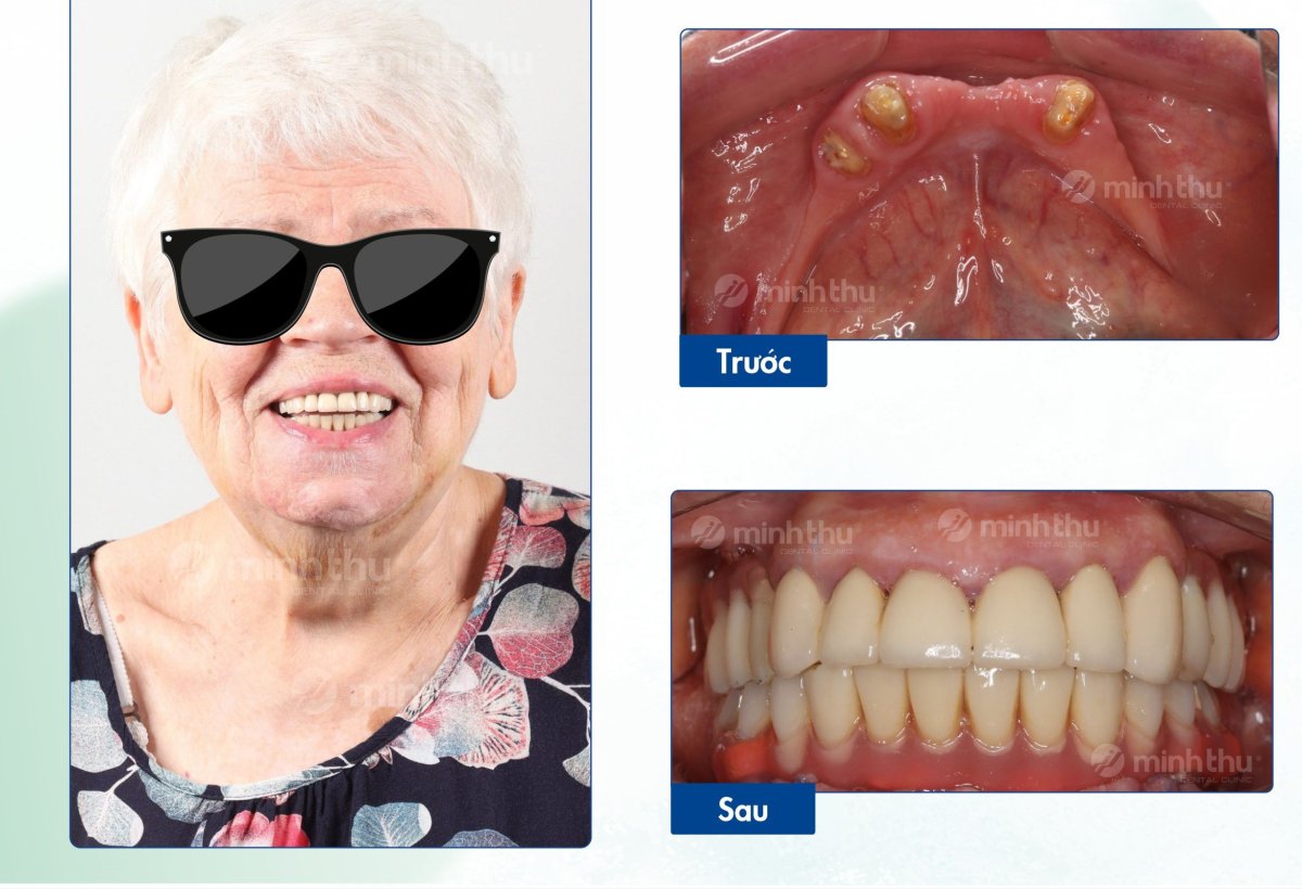 Vorher-nachher-Ergebnisse Zahnimplantat bei Minh Thu Dental Clinic, vollständiges Lächeln
