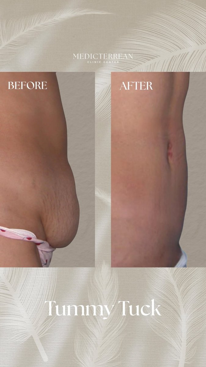 Résultats avant/après abdominoplastie au MEDICTERREAN Clinic Center, ventre plat
