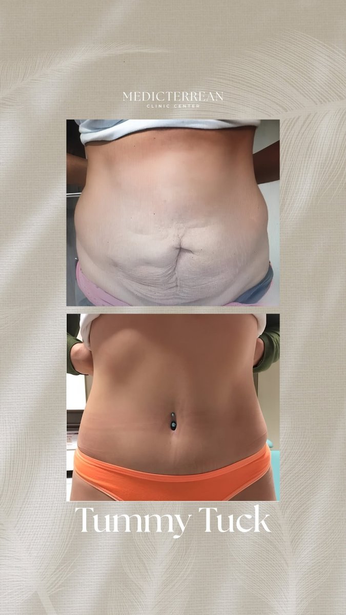 Before and after tummy tuck results at MEDICTERREAN Clinic Center, abdomen contour improved