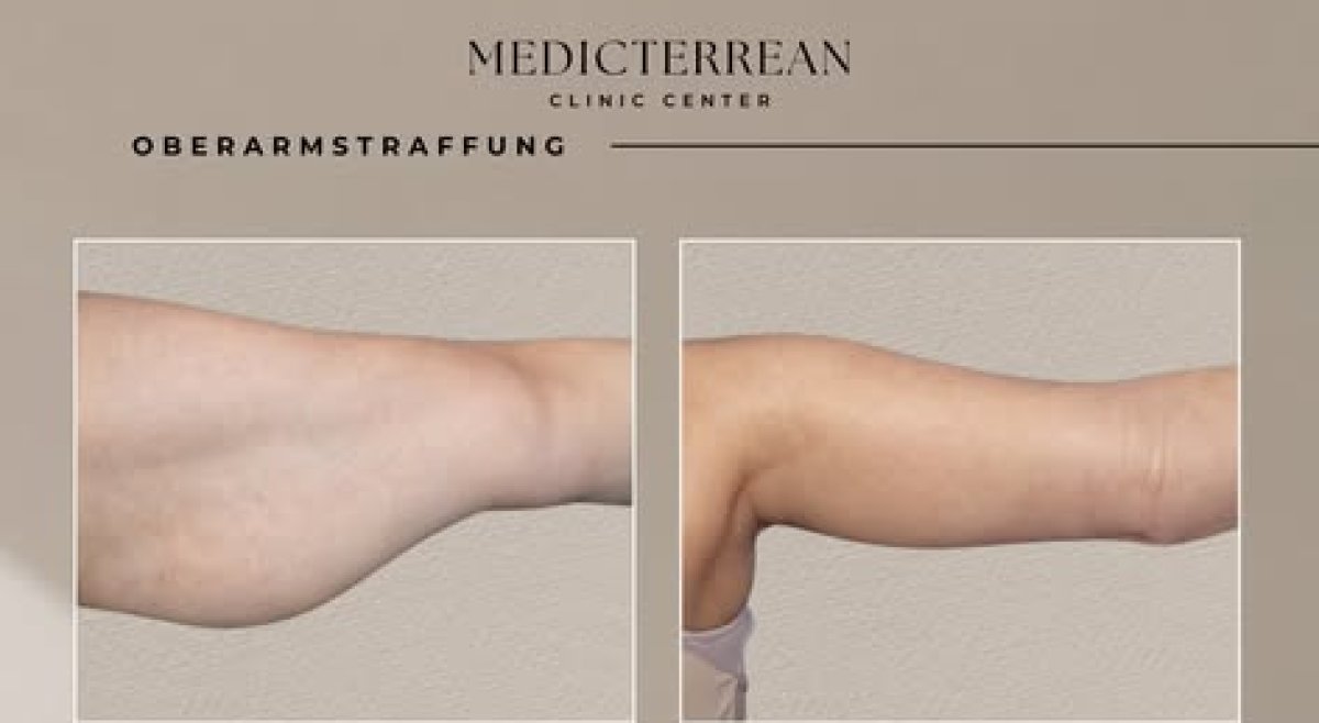 Before and after arm lift results at MEDICTERREAN Clinic Center, improved arm contour