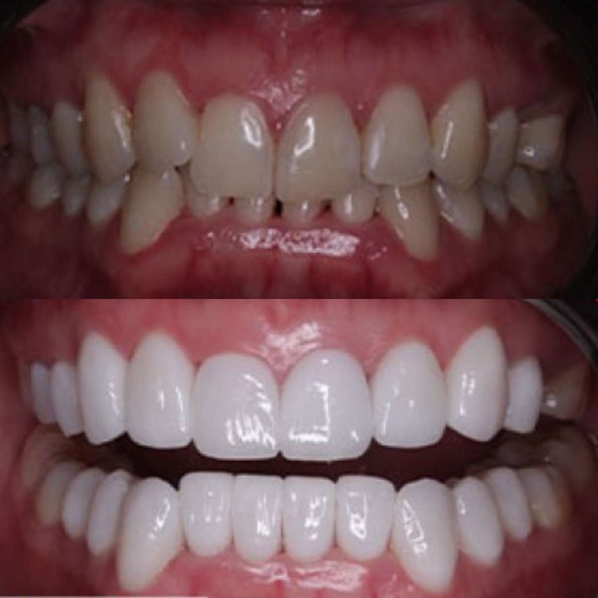 Before and after veneers at SAIGON CENTER DENTAL CLINIC, smile makeover results