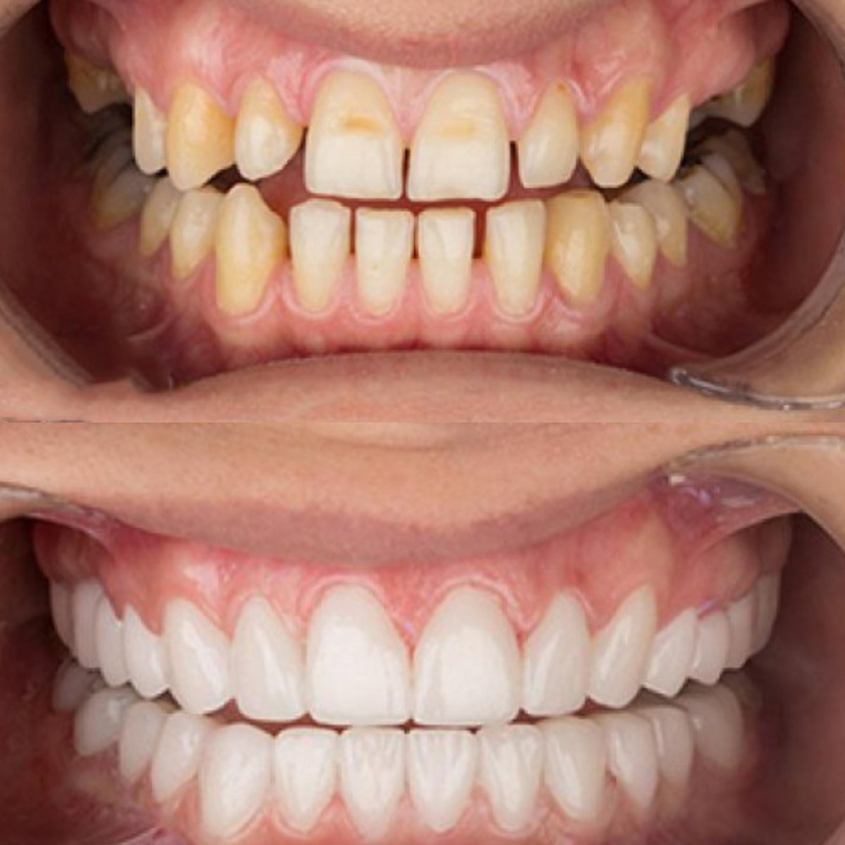 Before and after dental veneers at SAIGON CENTER DENTAL CLINIC, smile makeover result