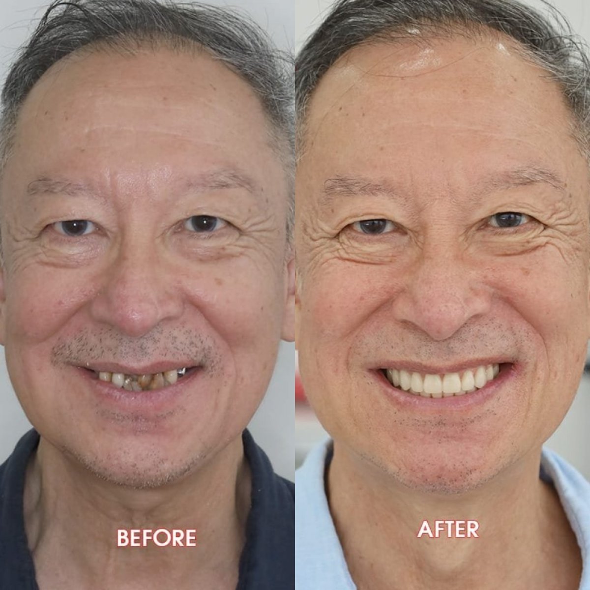 Before and after All-on-2 dental implants result at SAIGON CENTER DENTAL CLINIC, smile restored