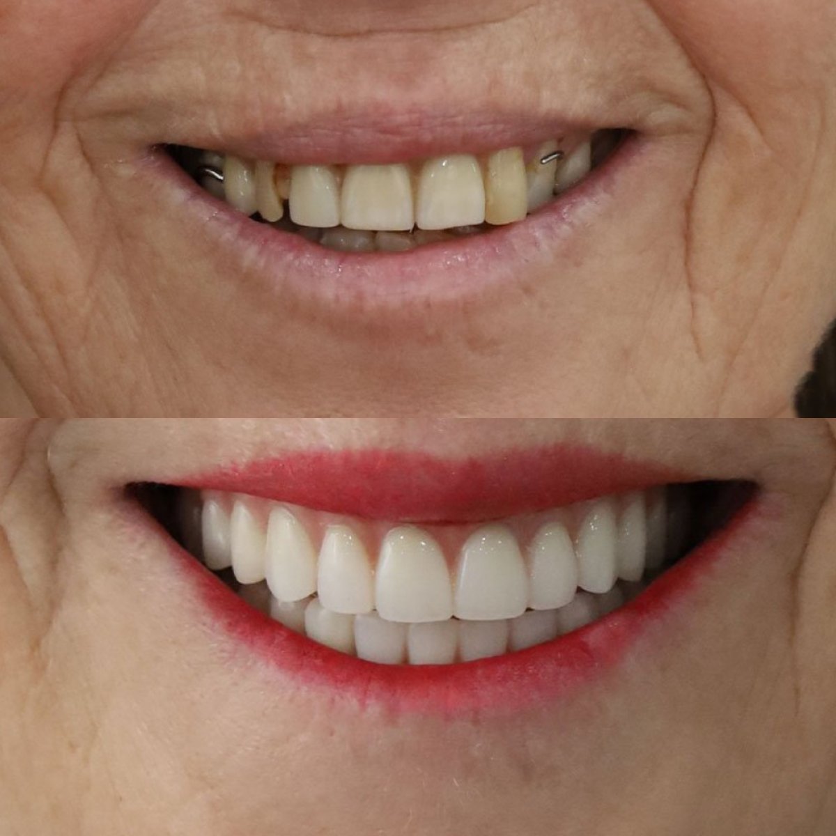 Before and after All-on-2 dental implants result at SAIGON CENTER DENTAL CLINIC, improved smile