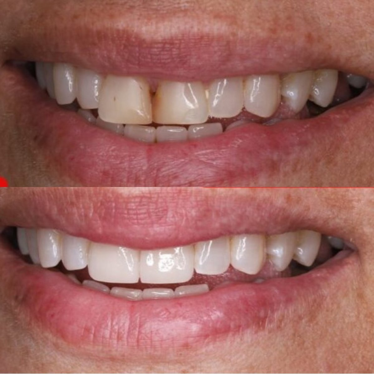 Before and after Hollywood Smile results at SAIGON CENTER DENTAL CLINIC, whiter even teeth