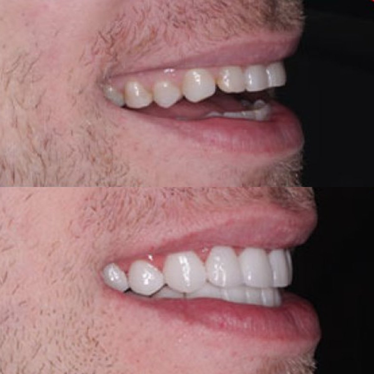 Before and after veneers result at SAIGON CENTER DENTAL CLINIC, improved smile aesthetics