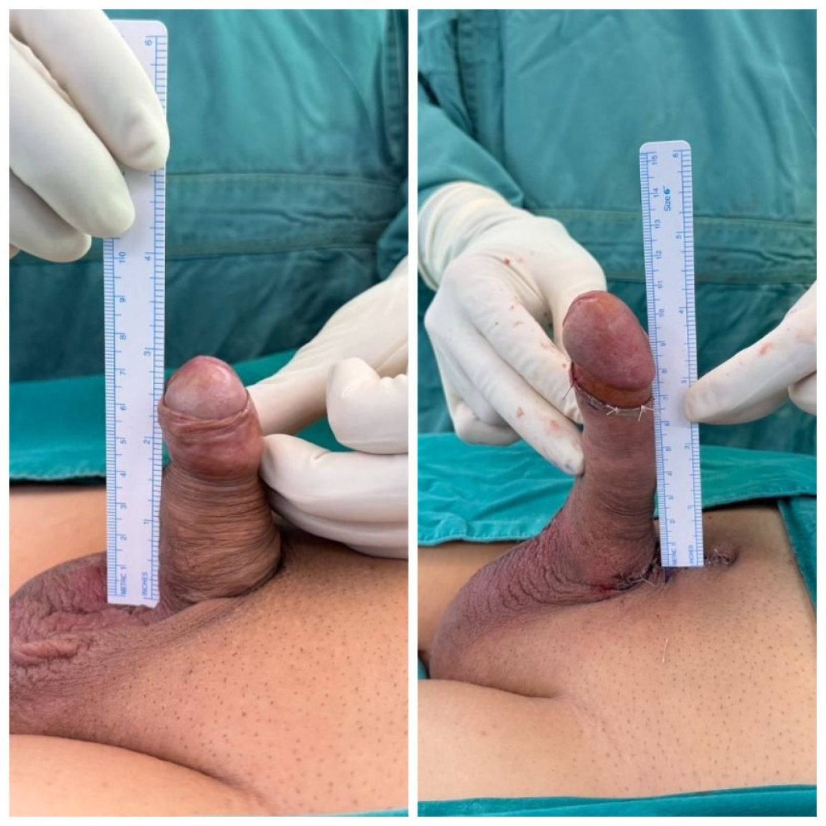 Before and after penile implant surgery results at Original Eternity Clinic Pleonchit