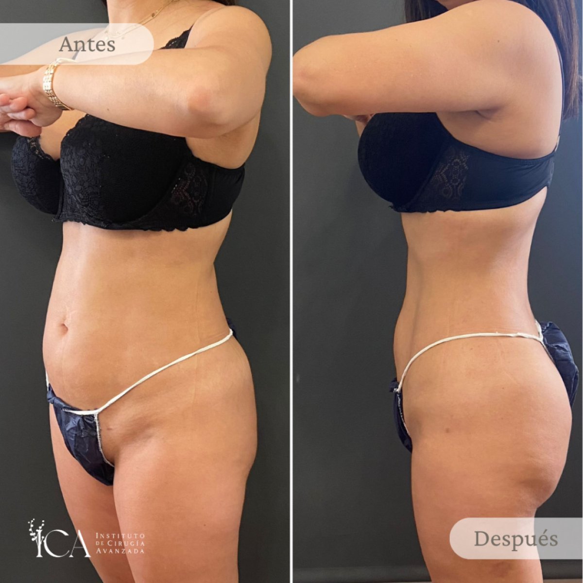 Before and after liposuction results at ICA, Instituto de Cirugía Estética Avanzada, body contouring