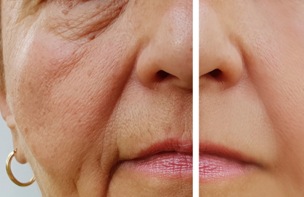 Mini facelift before and after results at ICA, Instituto de Cirugía Estética Avanzada