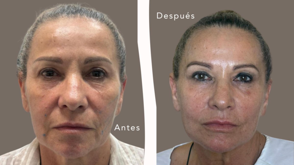 Before and after mini facelift results at ICA, Instituto de Cirugía Estética Avanzada