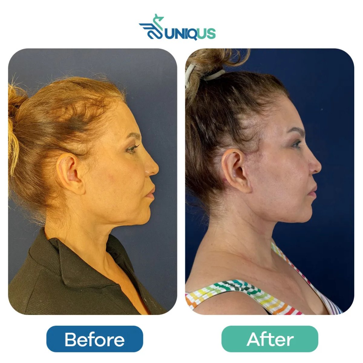 نتائج شد الوجه بالمنظار قبل وبعد في Uniqus Health – تحسين واضح لتحديد الوجه