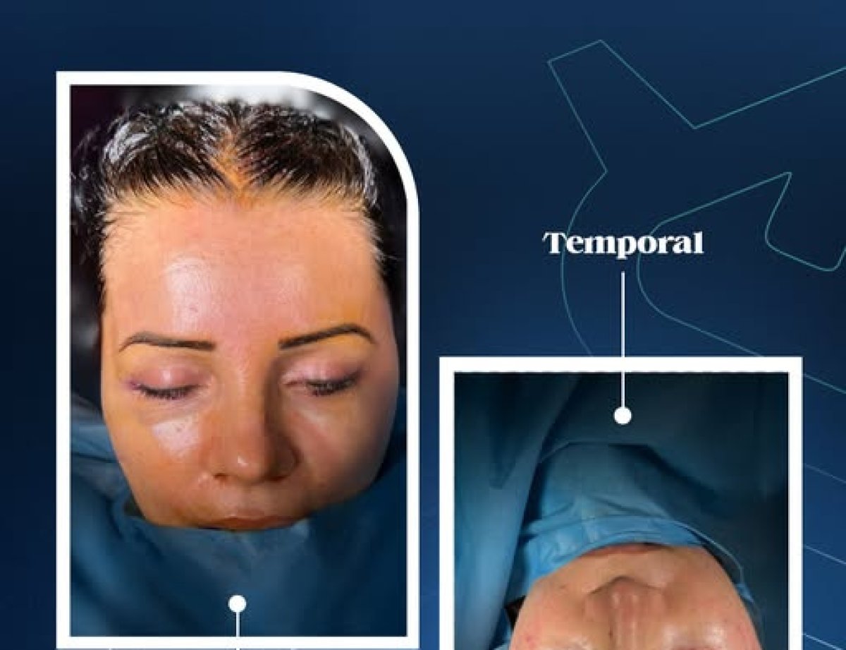 نتائج شد الوجه بالمنظار في Uniqus Health، رفع واضح للجبهة