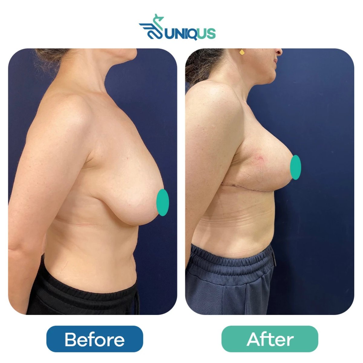 نتائج شد الثدي قبل وبعد في Uniqus Health، تحسين شكل وتماسك الثدي