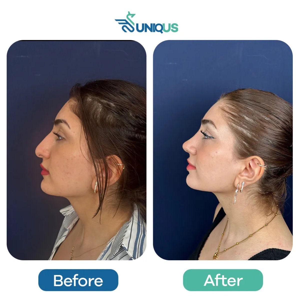 Before and after rhinoplasty results at Uniqus Health, improved nose shape and profile