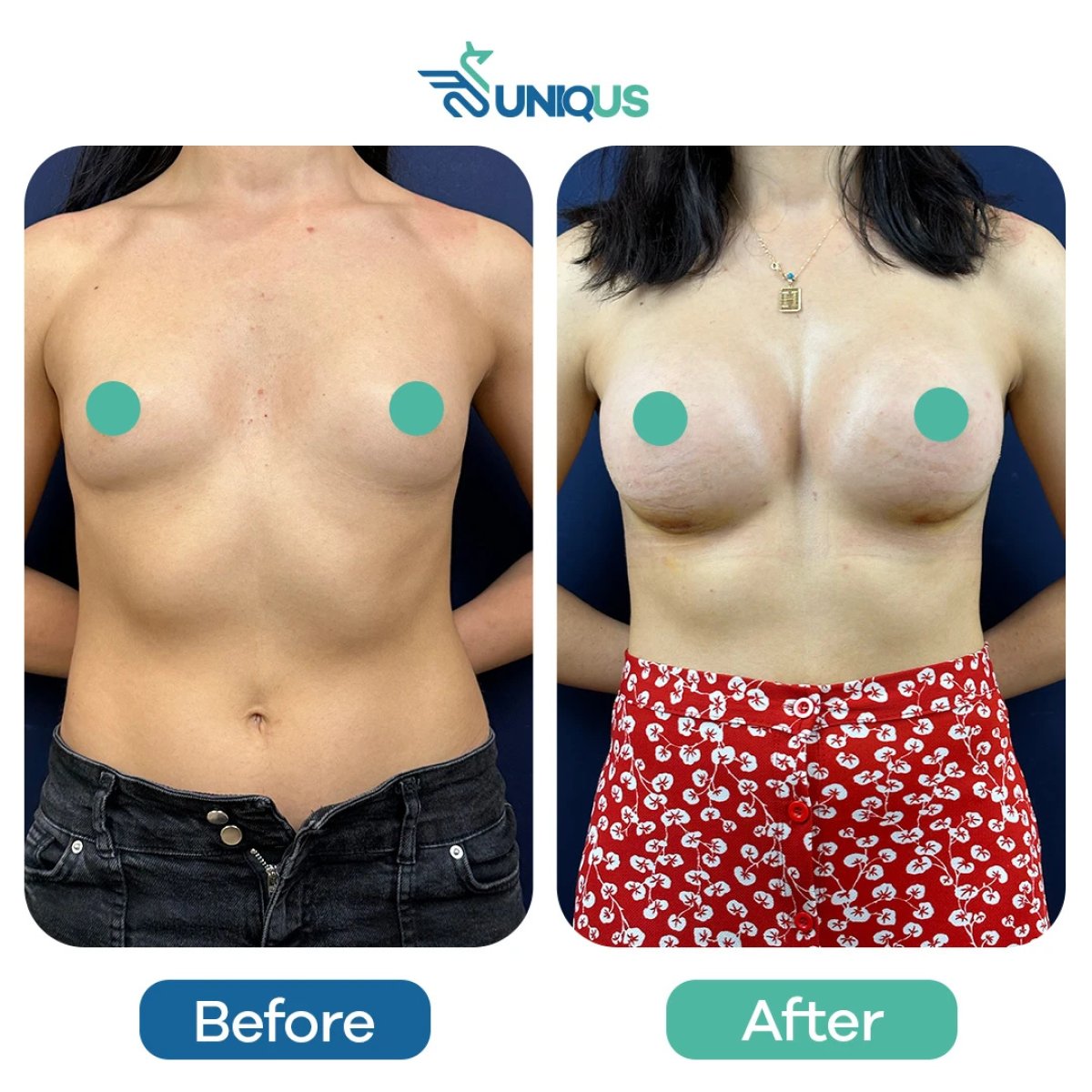 Before and after breast augmentation at Uniqus Health, visible increase in breast size result