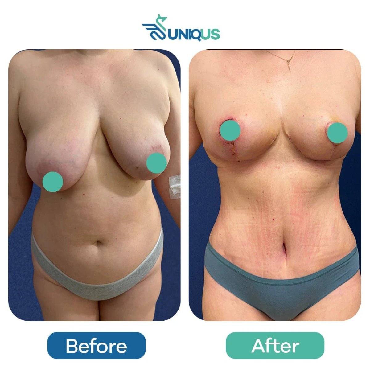 Before and after breast reduction results at Uniqus Health, improved breast shape and contour