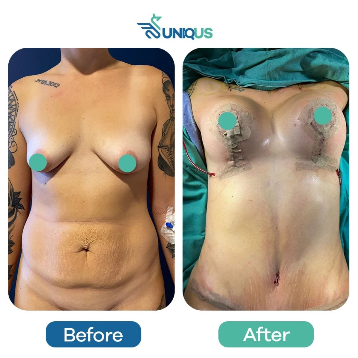 Resultados de abdominoplastia y liposucción antes y después en Uniqus Health, contorno visible