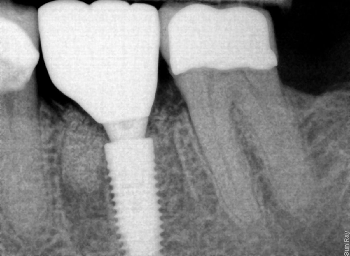 نتيجة زراعة الأسنان في SoftDentalCare Clinic، أشعة سينية تظهر ترميم السن الناجح