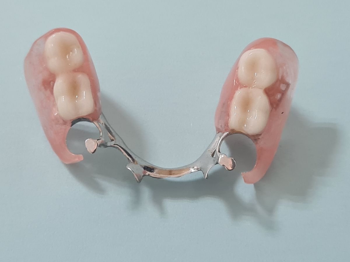 Partial denture result at SoftDentalCare Clinic, natural-looking replacement teeth solution