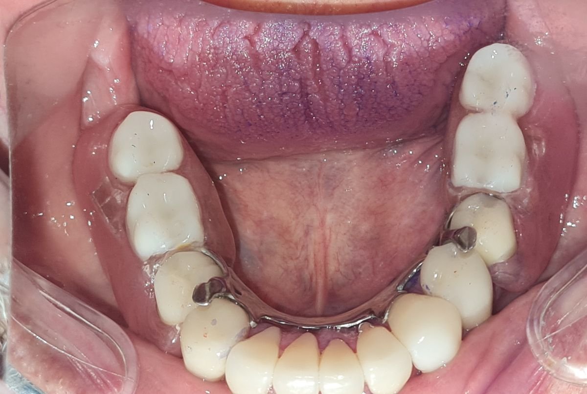 Lower jaw denture result at SoftDentalCare Clinic, restored teeth and improved bite alignment