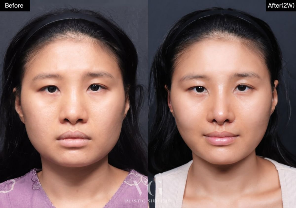 قبل وبعد زرع خدود في VG Plastic Surgery، تحسين حجم الخد وتحديد ملامح الوجه