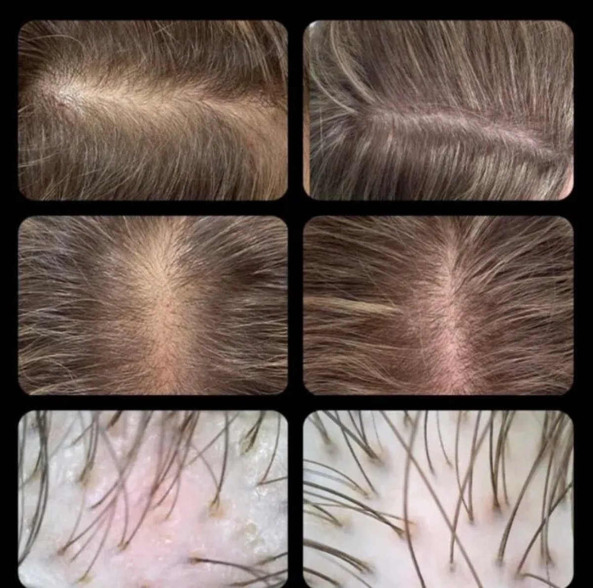 Vorher-nachher-Ergebnisse der Stammzelltherapie zur Haarwiederherstellung bei Mediland