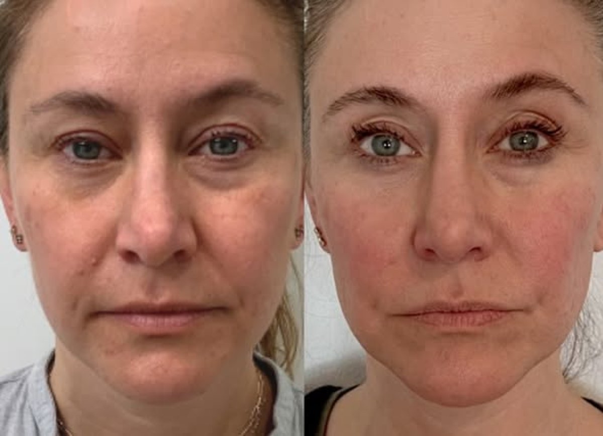 Vorher-nachher-Ergebnis der Stammzellverjüngung bei Mediland, sichtbare Anti-Aging-Wirkung