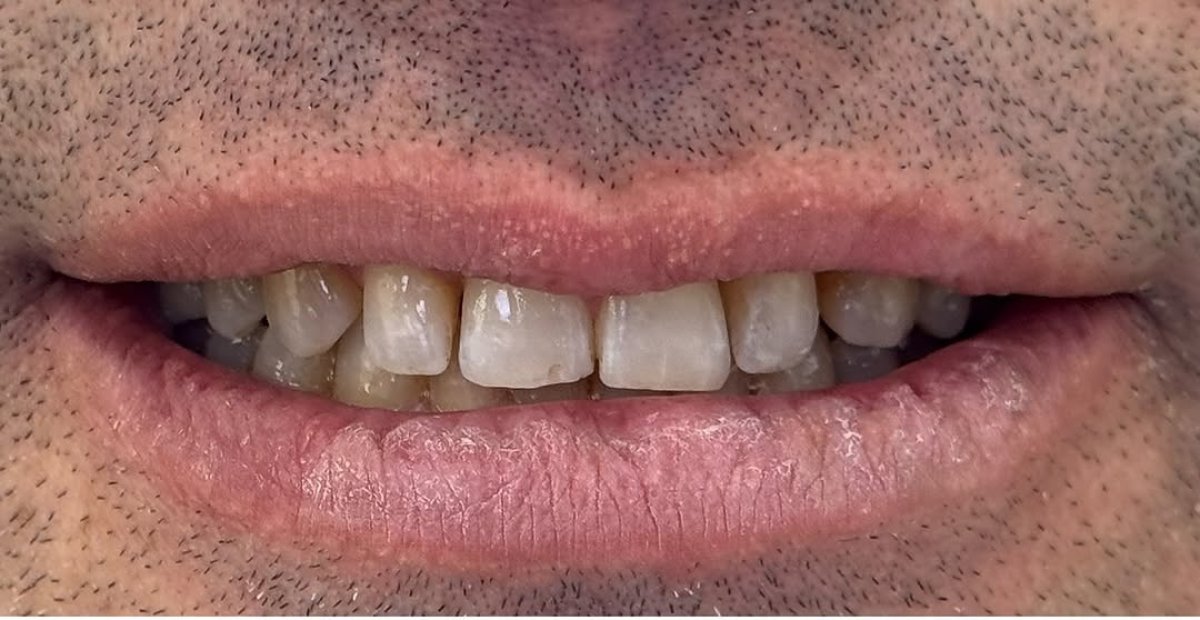 Before veneers procedure at Dental Turkey, visible tooth discoloration and uneven smile