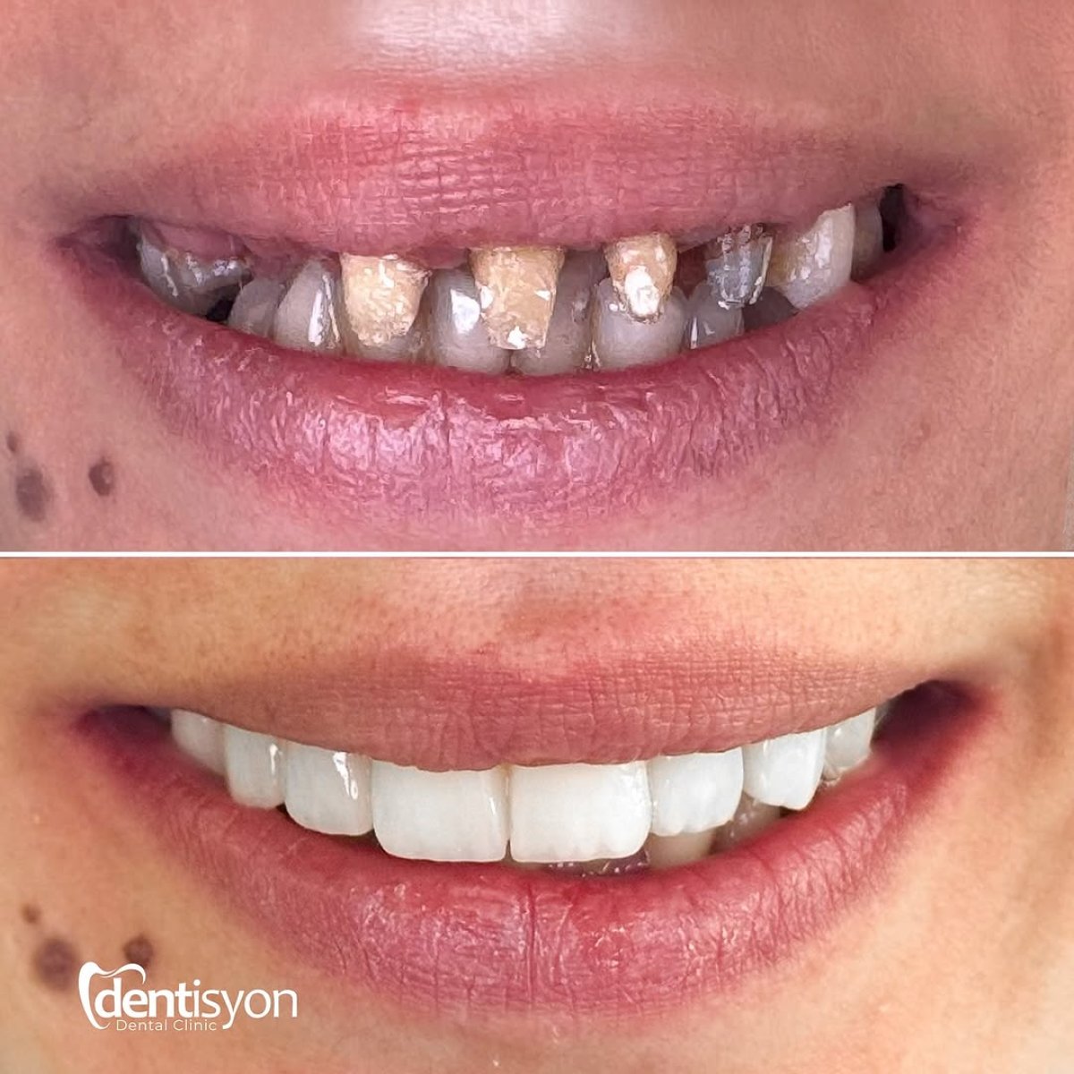 Before and after veneers at Dental Turkey – smile makeover with natural-looking white teeth result