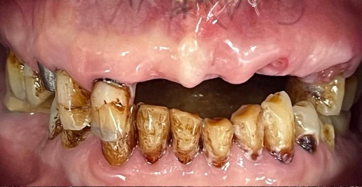 Stark zerstörte Zähne und Zahnverlust vor Hollywood Smile in der Al Fawzy Dental Clinic