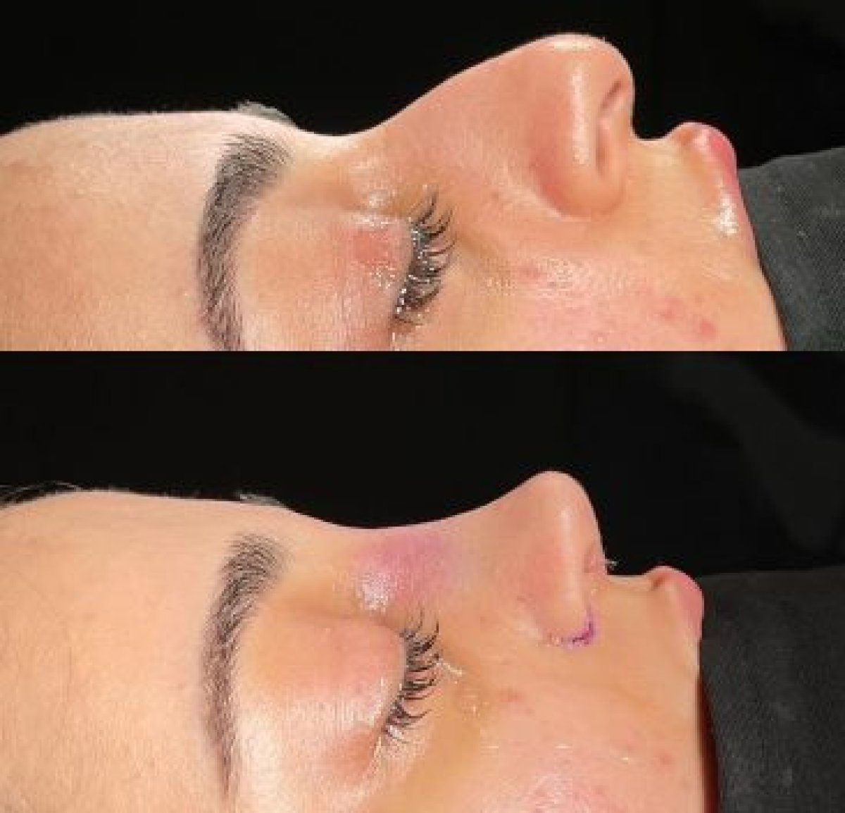 Resultado antes y después de eliminación de giba nasal en Dr.Yunus Kaplan - Rhinoplasty Surgeon