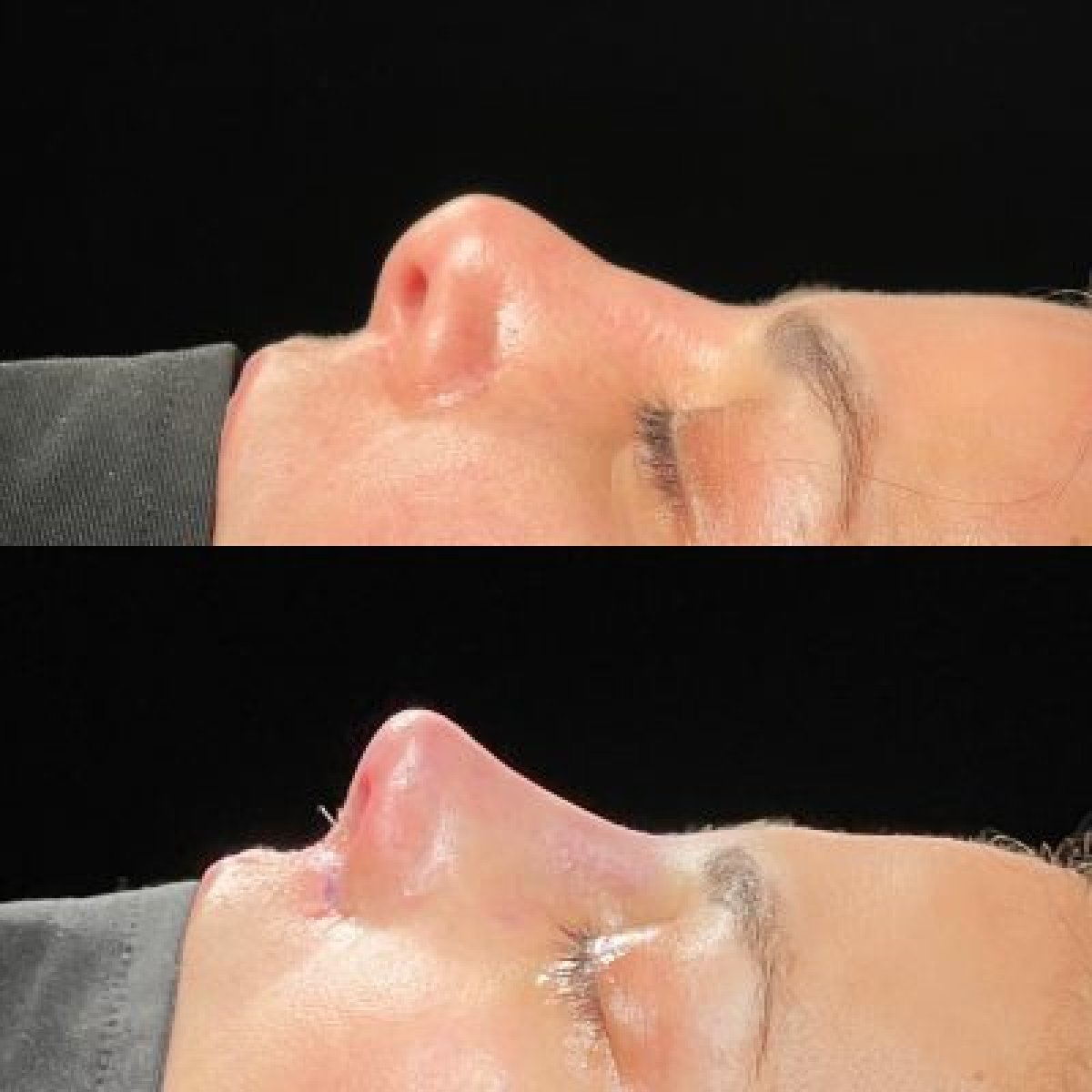 Результати до і після видалення горбинки носа в клініці Dr.Yunus Kaplan - Rhinoplasty Surgeon