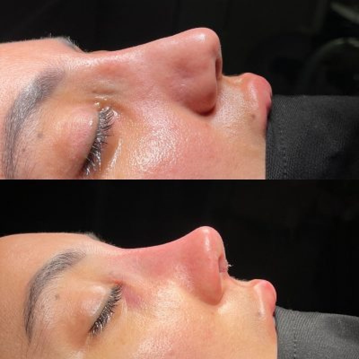 Before and after nasal hump removal results at Dr.Yunus Kaplan - Rhinoplasty Surgeon clinic