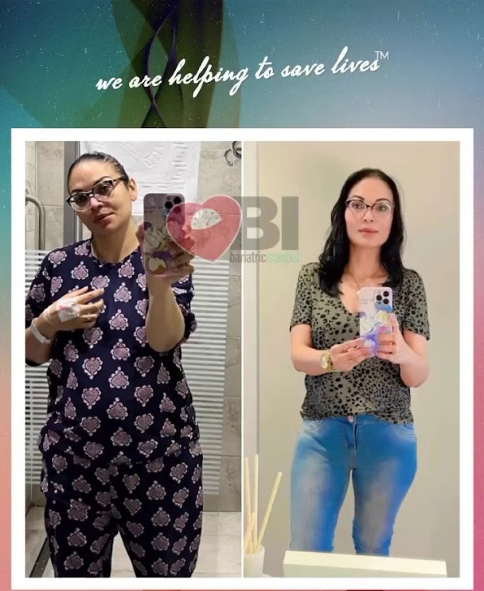 Résultats avant et après sleeve gastrectomie chez Bariatric Istanbul – perte de poids visible