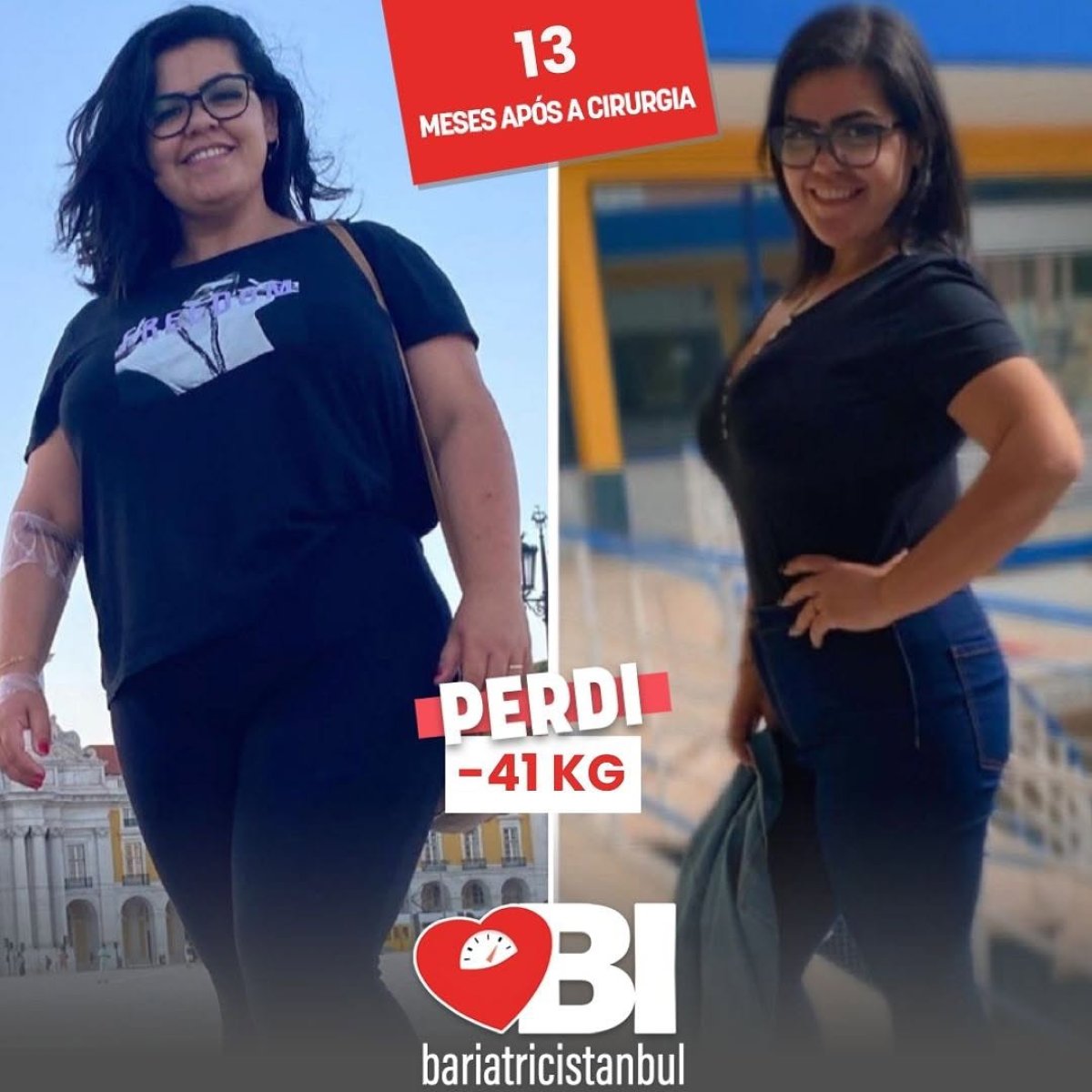Результат до и после гастрошунтирования в Bariatric Istanbul, снижение веса на 41 кг