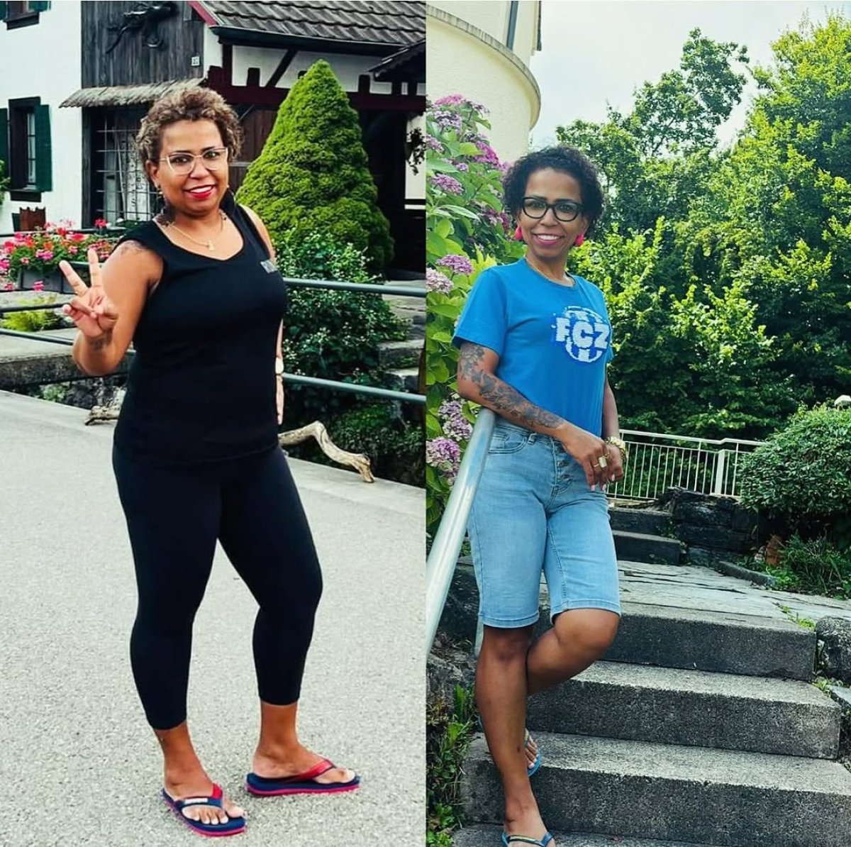 Przed i po operacji metabolicznej w Bariatric Istanbul – widoczna utrata wagi