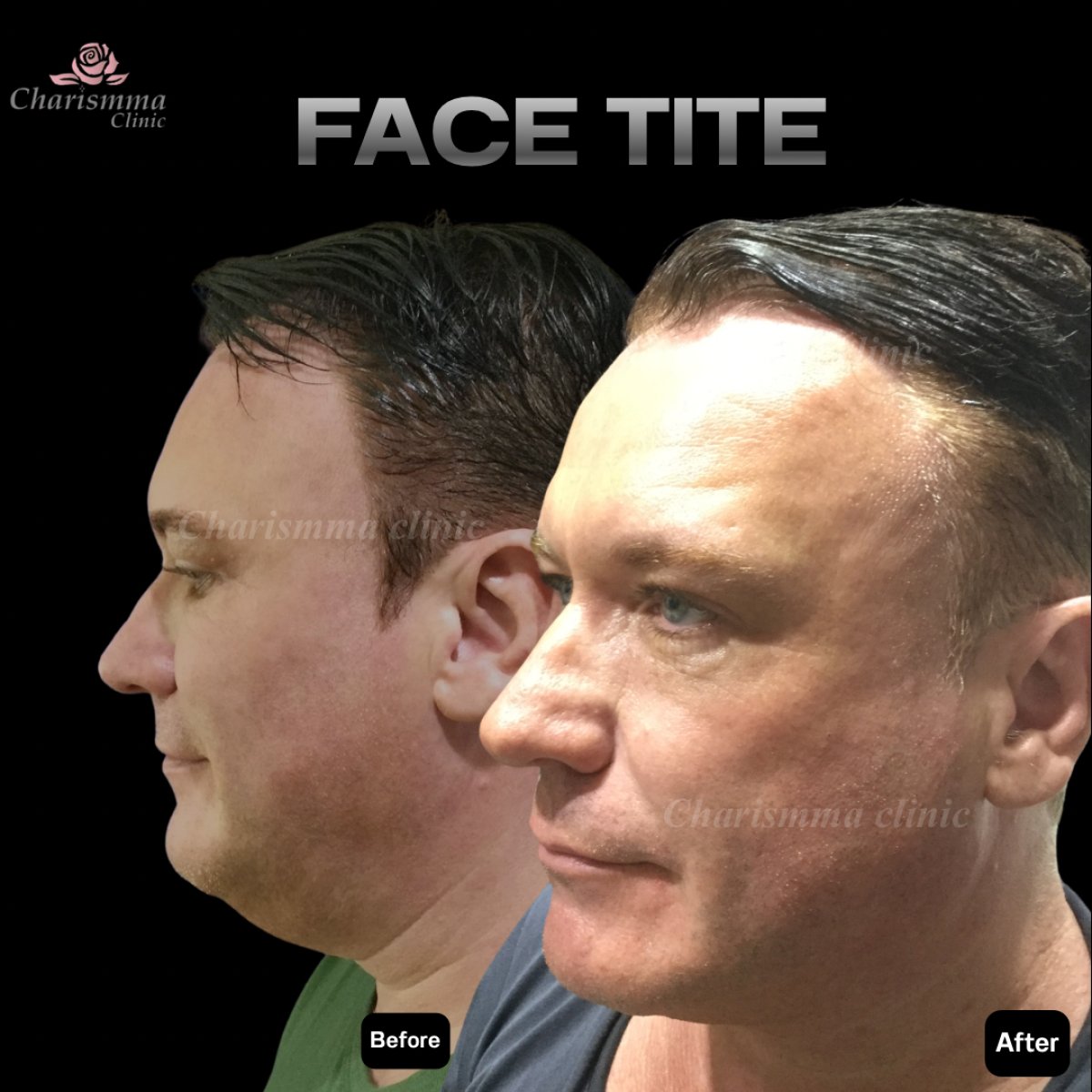 Before and after FaceTite results at Charismma Clinic – visible facial contour improvement