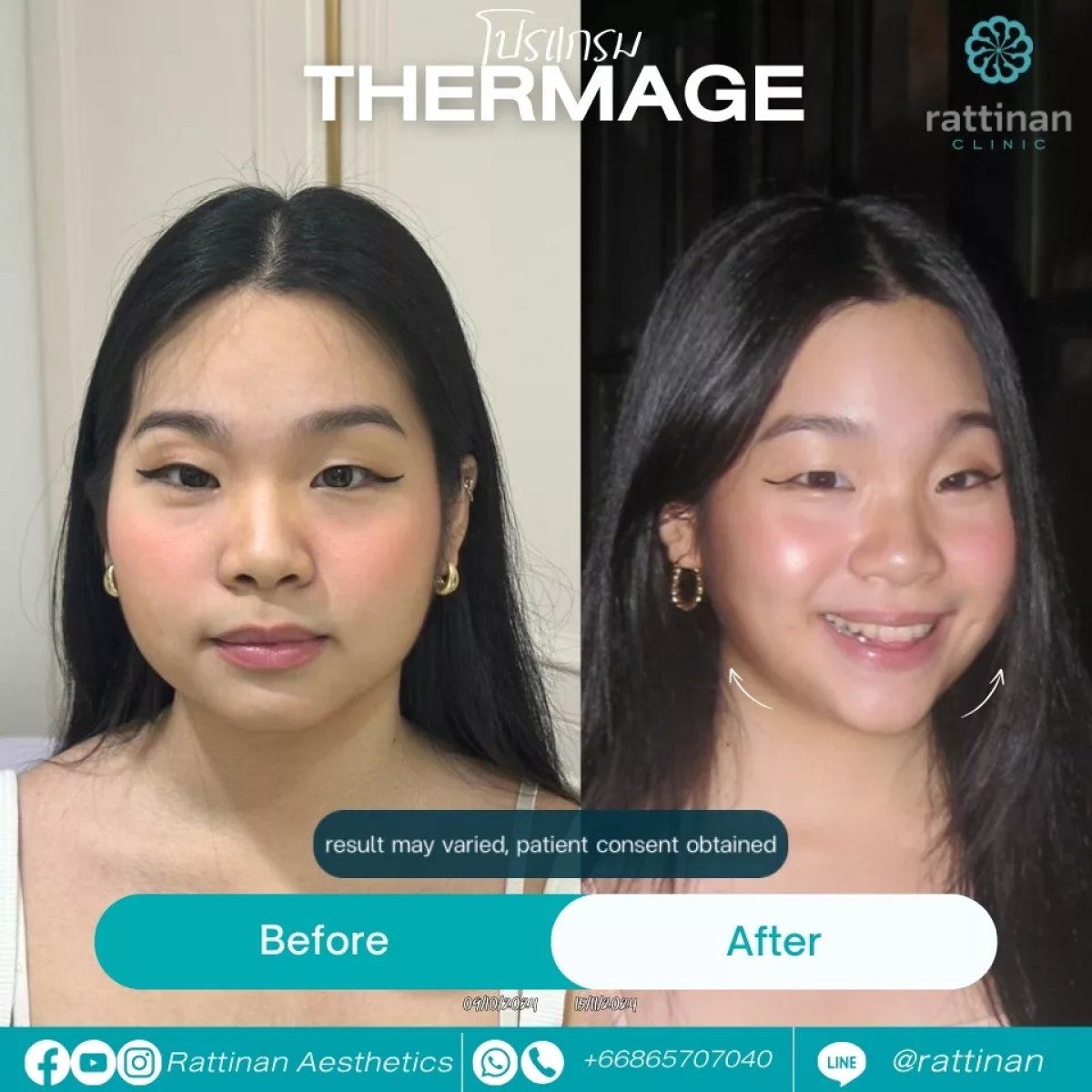 Before and after Thermage results at Rattinan Clinic, visible facial skin tightening effect