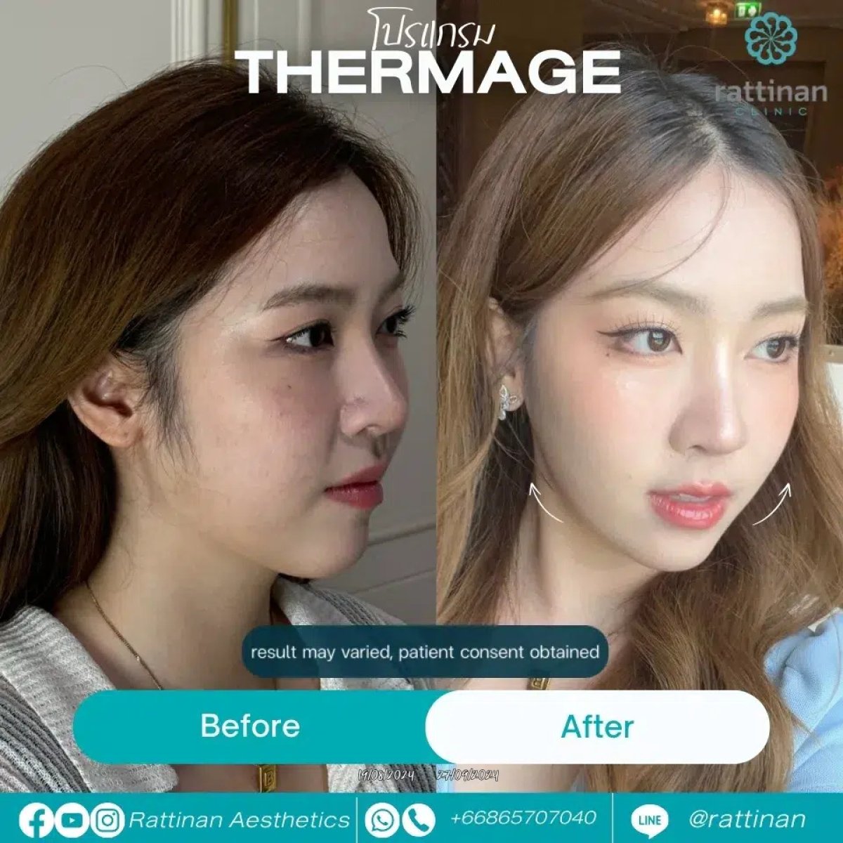 Before and after Thermage results at Sarinya Clinic – visible facial skin tightening effect